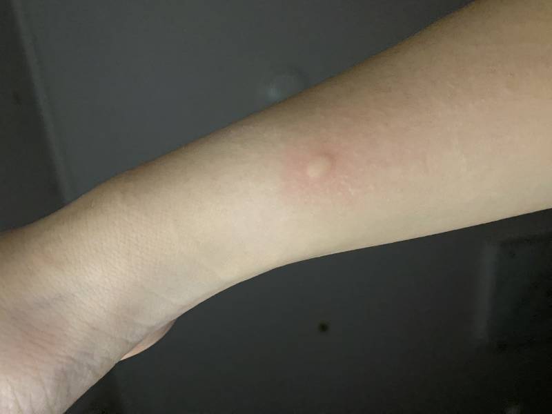 내 팔 사진 있어❗️물린거 아닌데 같은 자리에 아주 가끔 모기 물린것처럼 간지러운게 올라와 이게 뭐지 | 인스티즈