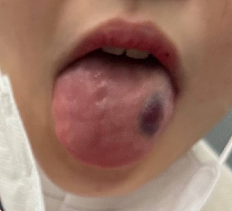 어제 혀씹어서 혀에 멍이 크게 들었거든 병원 가야해? (혐오주의) | 인스티즈