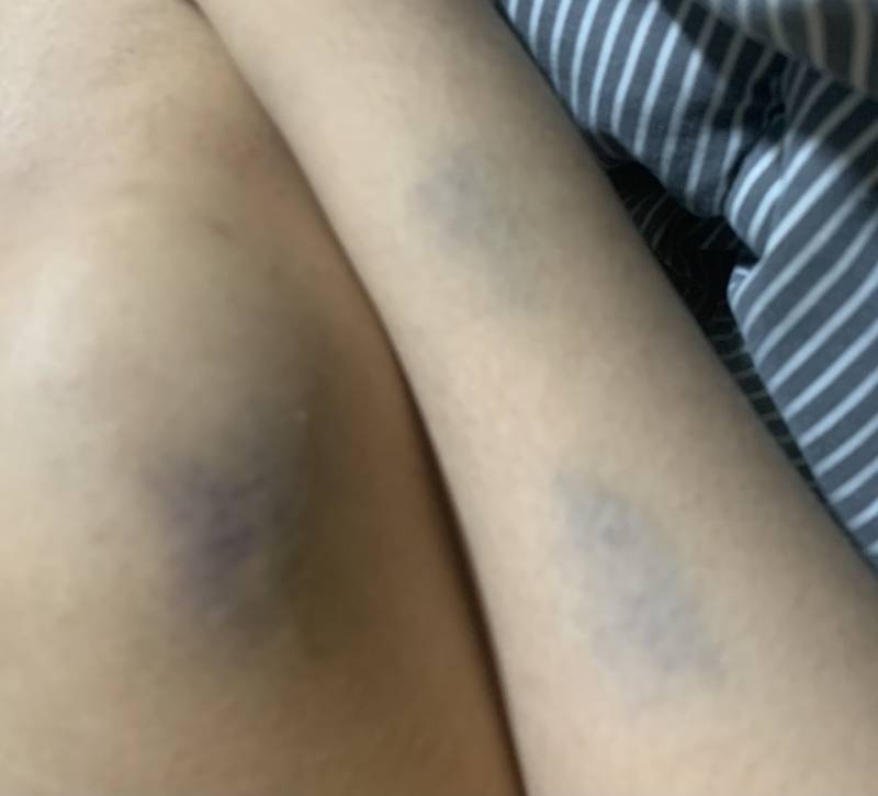 내 몸인데 왜 멍들었는지 모르겠다ㅋㅋㅋ | 인스티즈