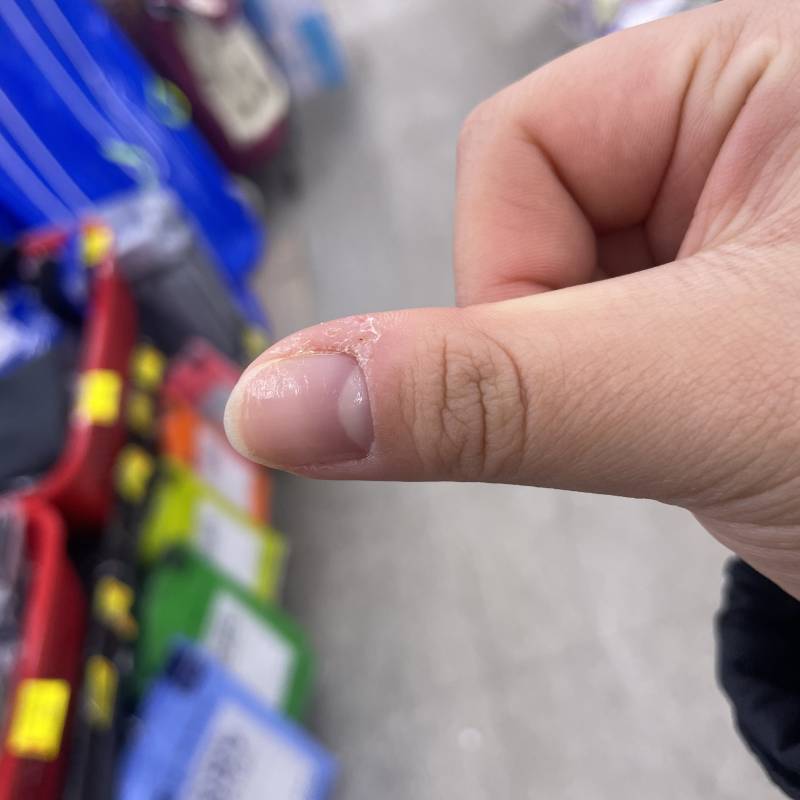 손톱 주변 이런거 어케 해ㅠㅠㅠ? | 인스티즈