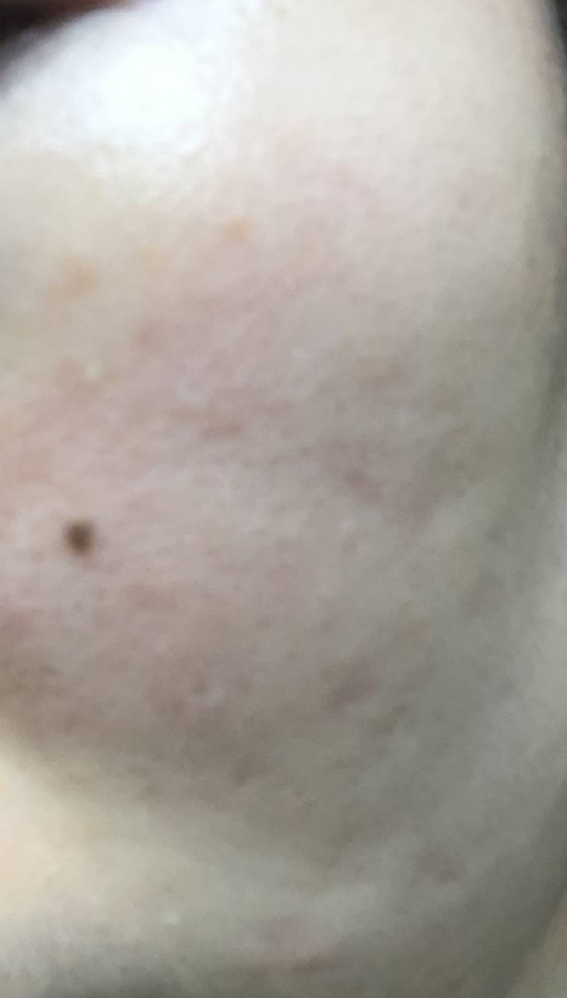 나 이거 피부염 중에 뭐인 거 같아??? ㅎㅇㅈㅇ | 인스티즈