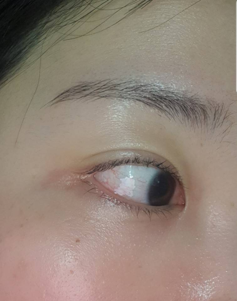 얘들아 나 365일 눈이 이렇게 충혈되어있는데 | 인스티즈