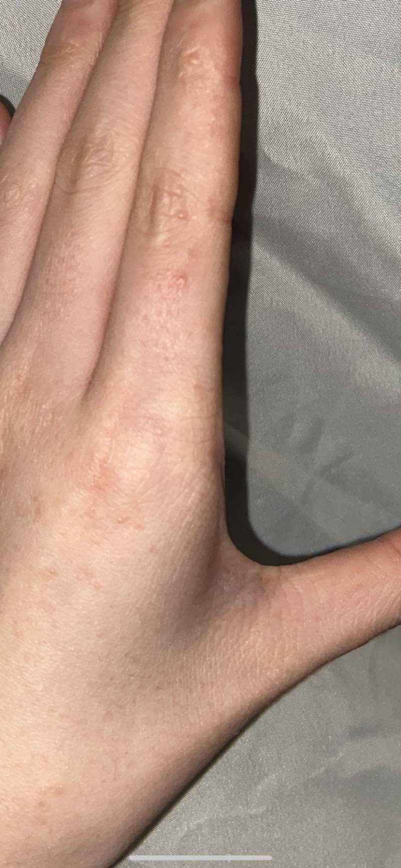 이거 한포진이야? | 인스티즈