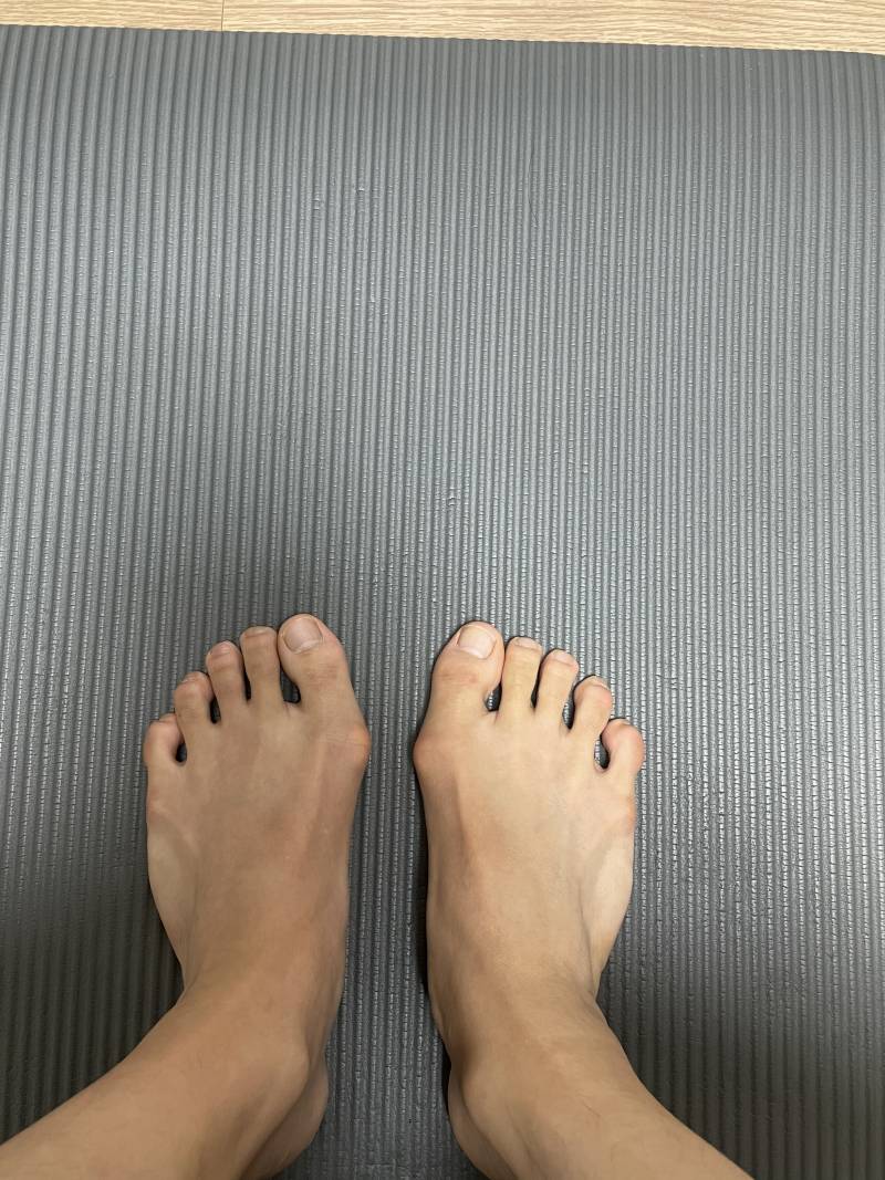 무지외반증 수술해봤거나 잘 아는익들 나 심한편이야? | 인스티즈