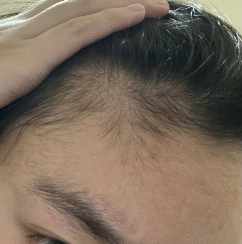 익들아 이거 탈모 고칠 수 있을까 ㅠ ㅎㅇㅈㅇ | 인스티즈