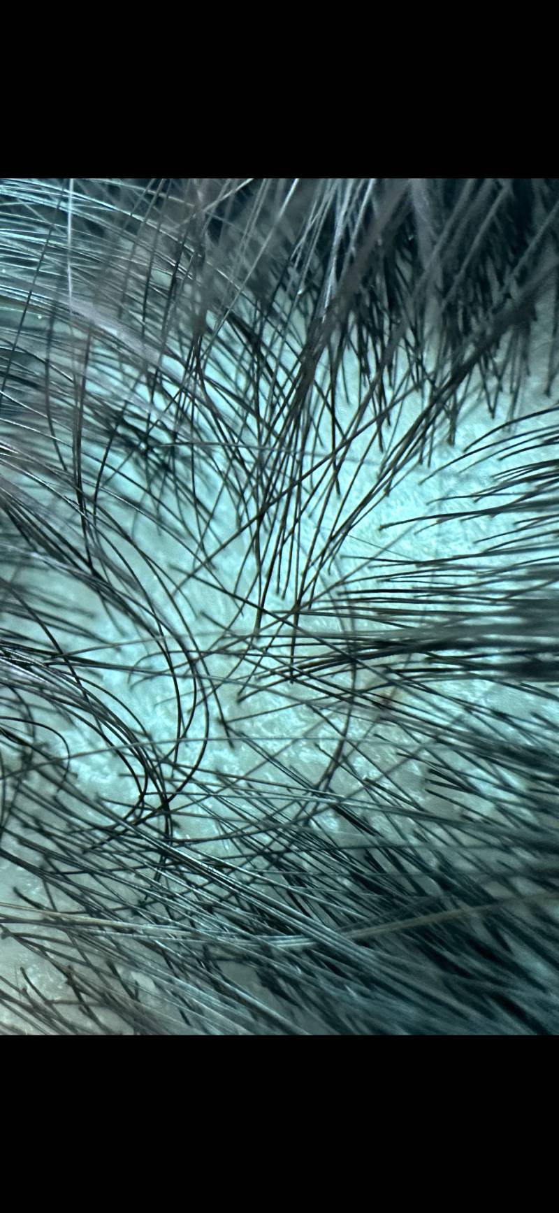 혹시 이거 지루성 두피염이야? (ㅎㅇㅈㅇ) | 인스티즈