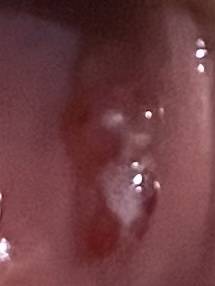 ㅎㅇㅈㅇ 입술 안에 이렇게 터지는 건 왜 터지는 거야..? | 인스티즈