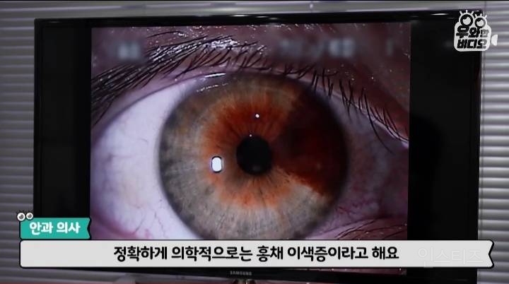 오드아이를 가진 한국인 (세상에 이런일이) | 인스티즈