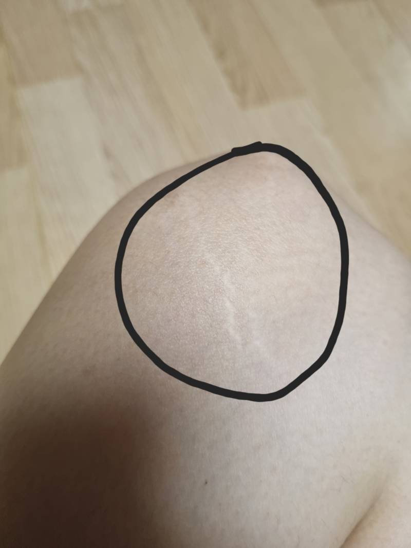 [잡담] 이게 셀룰라이트야?? | 인스티즈