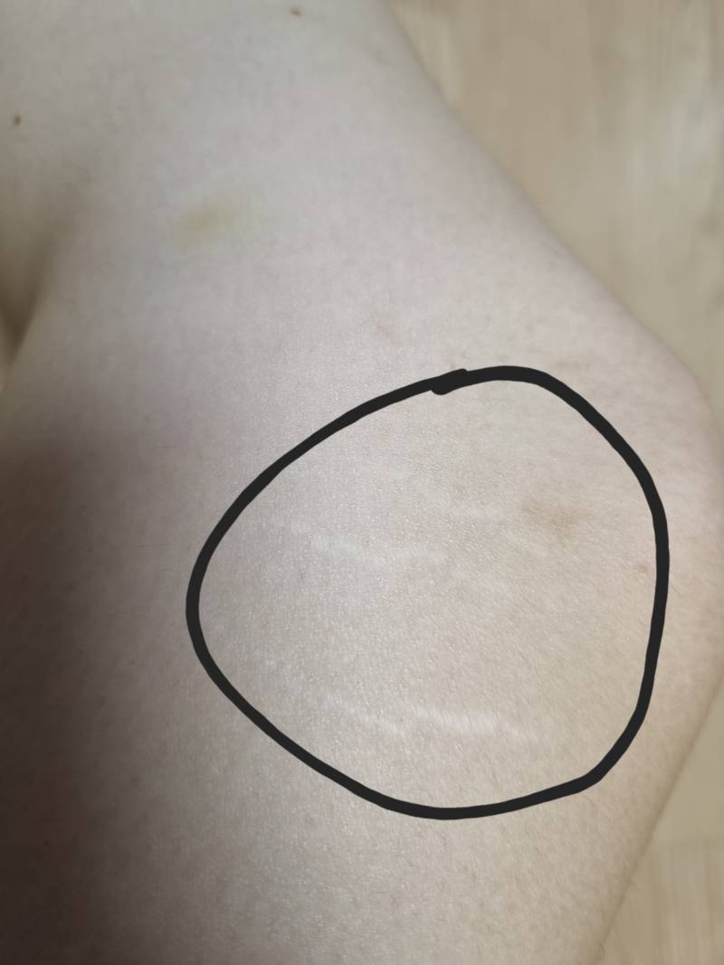 [잡담] 이게 셀룰라이트야?? | 인스티즈