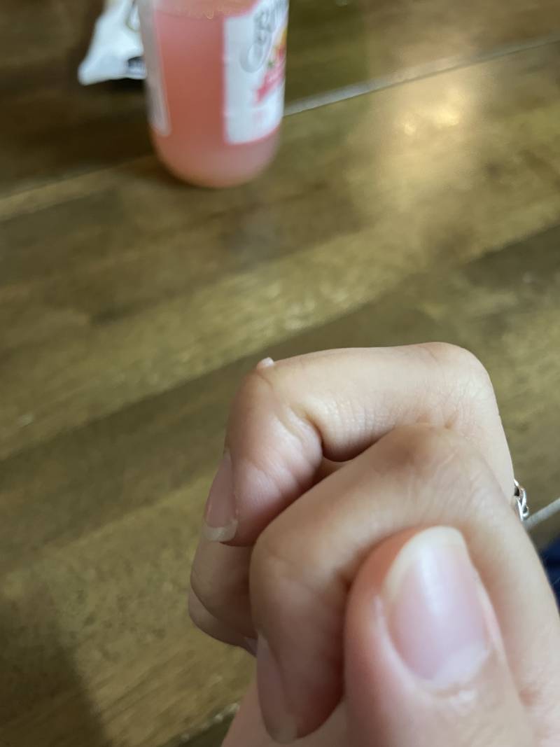 손가락에 이거 사마귄지 뭔지는 모르겠는데 생겼거든? | 인스티즈