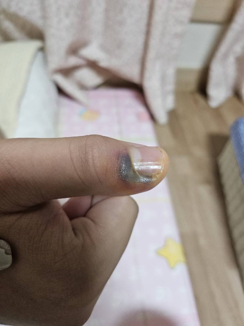 [잡담] !!!!!!의료쪽 애들아 급해ㅠㅠㅠㅠ손가락 이거 괴사같은거야....? | 인스티즈