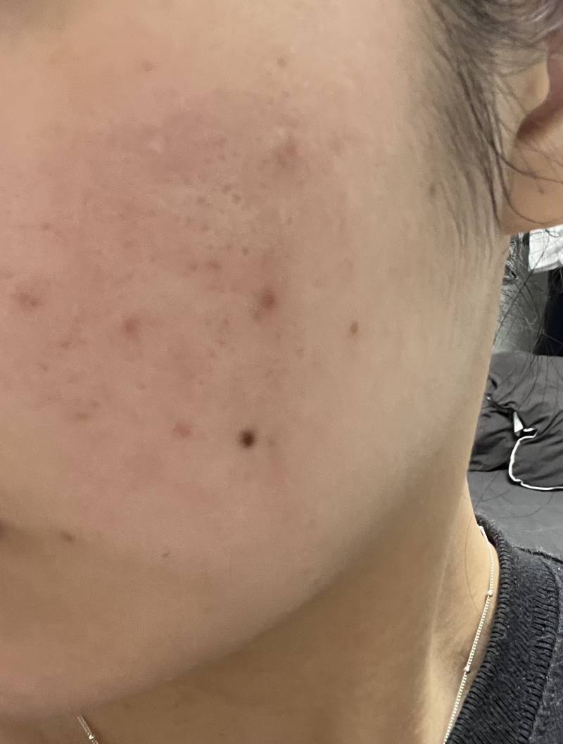 [잡담] 세수하고 스킨케어 한 후에 피부 이런데 피부염일까ㅠㅠ(모공주의) | 인스티즈