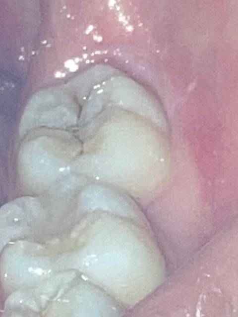 [잡담] 하 망했다 이거 충치맞지...ㅜ | 인스티즈