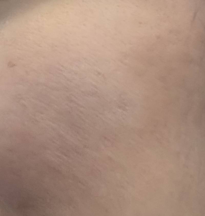 [잡담] 나보다 피부 안좋은 사람 있어 ? ㅎㅇㅈㅇ | 인스티즈