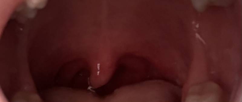 [잡담] 이거 편도 많이 부은거야?ㅎㅇㅈㅇ | 인스티즈