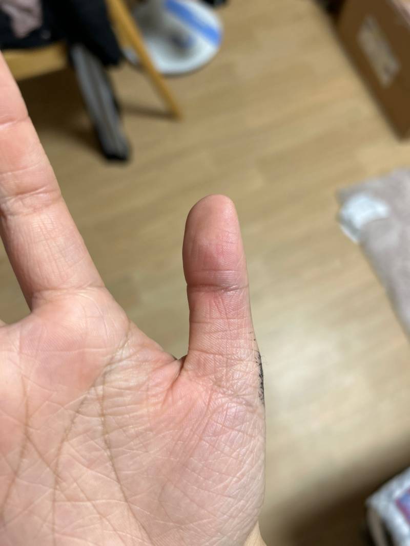 [잡담] 갑자𓅿𓂭 엄지손가락이 너무 아ㅏㅡ | 인스티즈