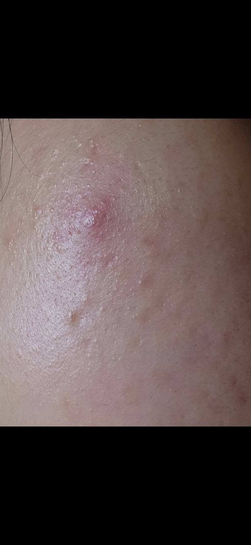 [잡담] 여드름 이 정도면 염증주사 맞아야될꺼.......아 보기싫어ㅠ | 인스티즈