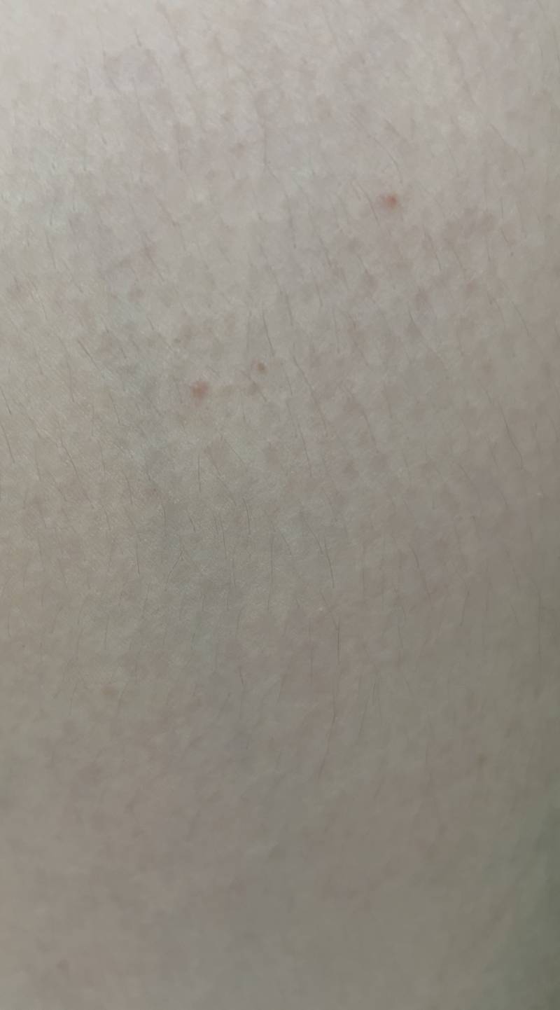 [잡담] 익들아 다리에 이런 게 갑자기 막 생겼는데 | 인스티즈