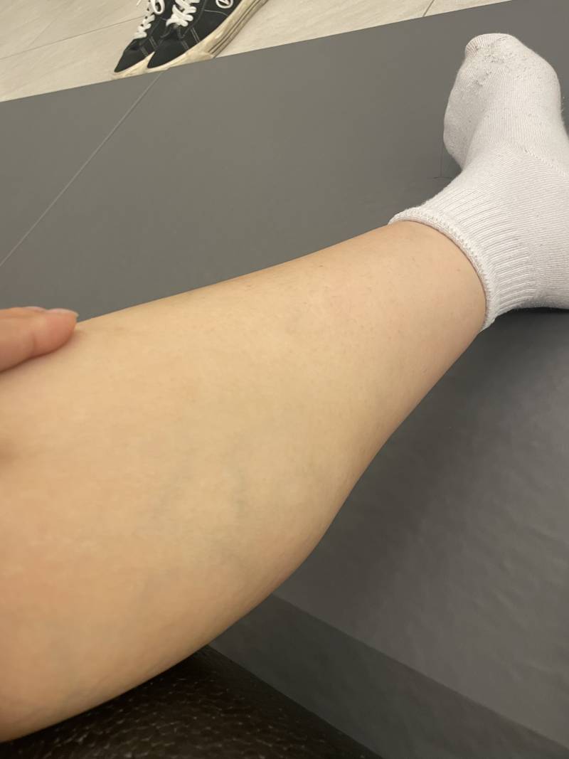 [잡담] 나 하지정맥류같애??? ㅠㅠ | 인스티즈
