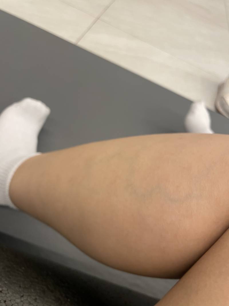 [잡담] 나 하지정맥류같애??? ㅠㅠ | 인스티즈