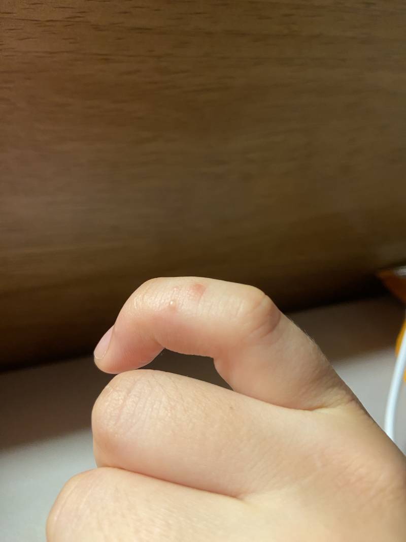 [잡담] 손가락에 이상한 거 생겼는데 | 인스티즈