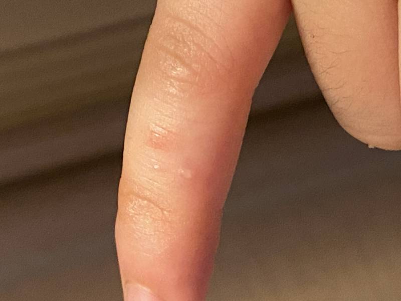 [잡담] 손가락에 이상한 거 생겼는데 | 인스티즈