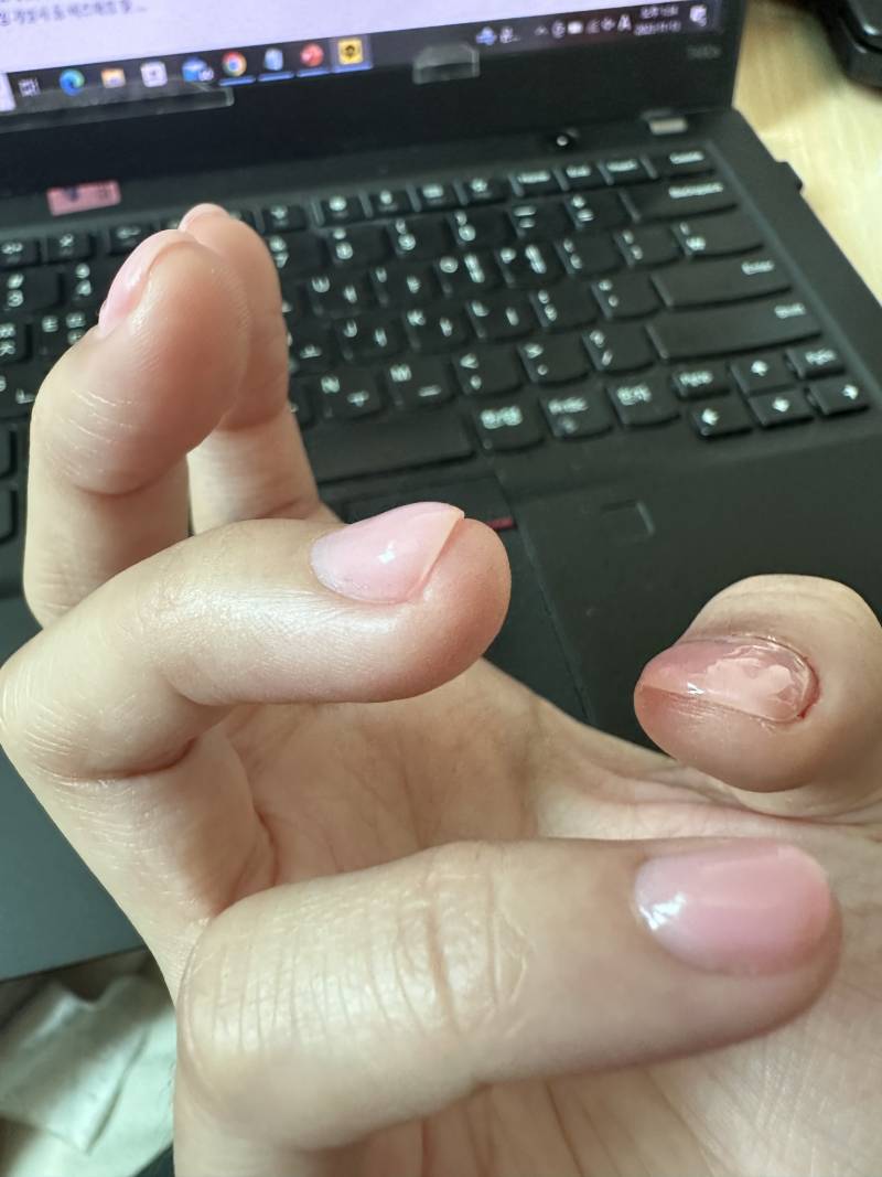 [잡담] [유혈사진주의] 인생 첫 젤네일 했는데 원래 이거 맞아? | 인스티즈