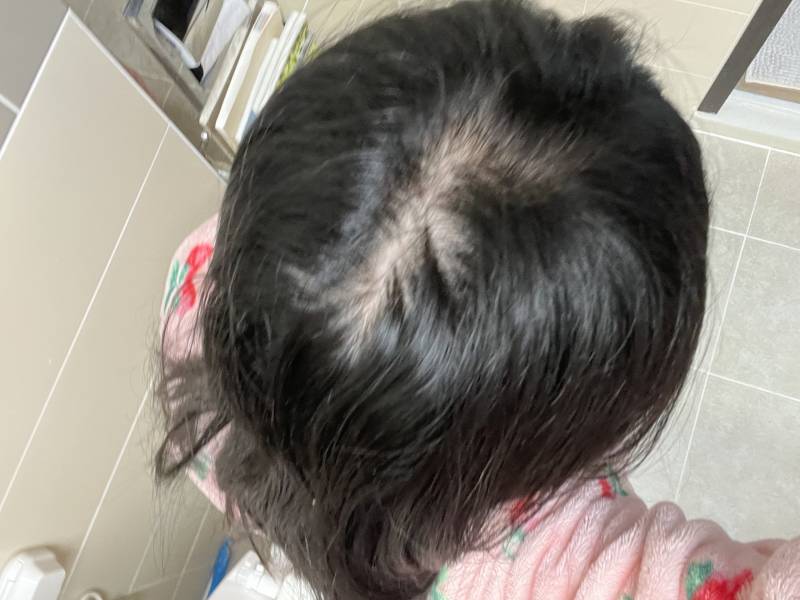 [잡담] 로게인폼 잠깐발랏다가 평생발라야한대서 끊엇는데 다라야할까 | 인스티즈