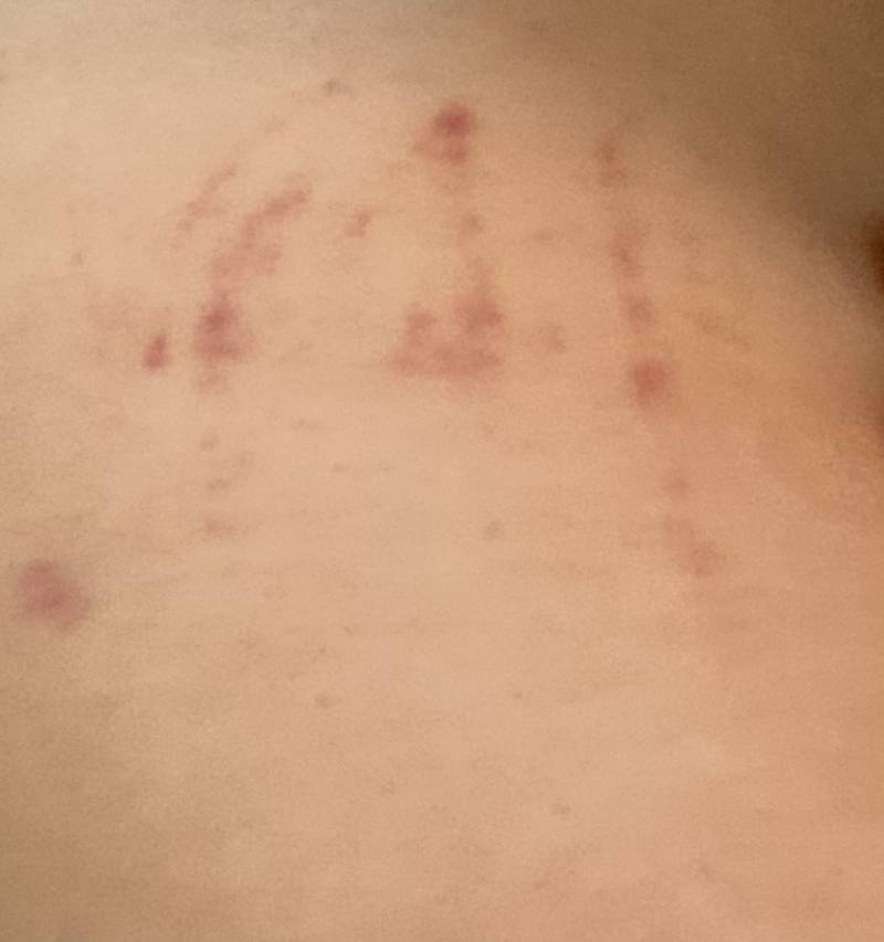 [잡담] ㅎㅇㅈㅇ 어깨에 이런 상처가 있는데 뭘까..? | 인스티즈