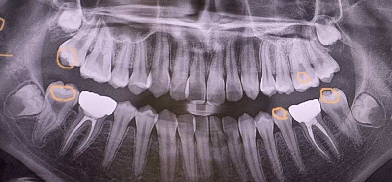 [잡담] 나 사랑니 어떤거같아🦷😬 | 인스티즈
