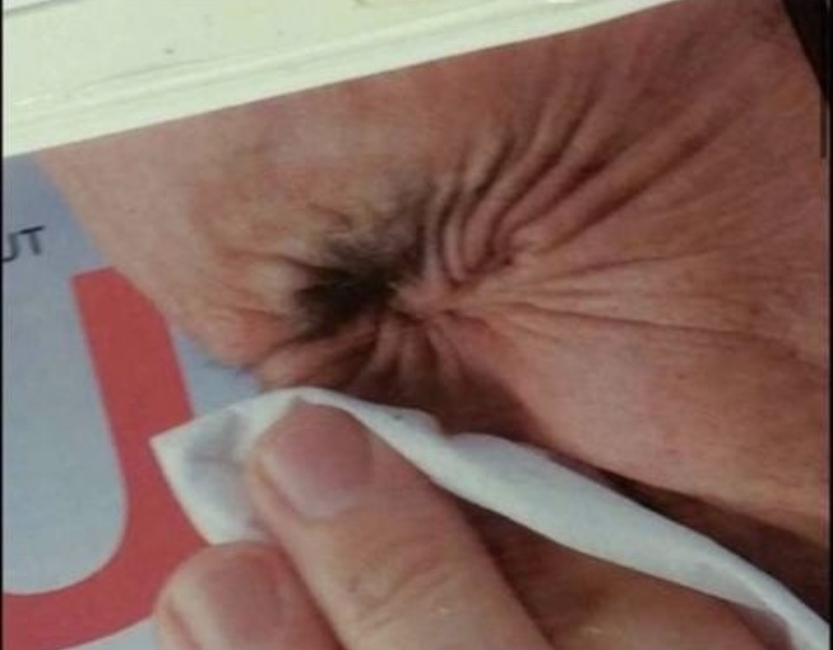 [잡담] 얘들아 나 똥꼬에 뭐 난 것 같아 ㅜㅜ | 인스티즈