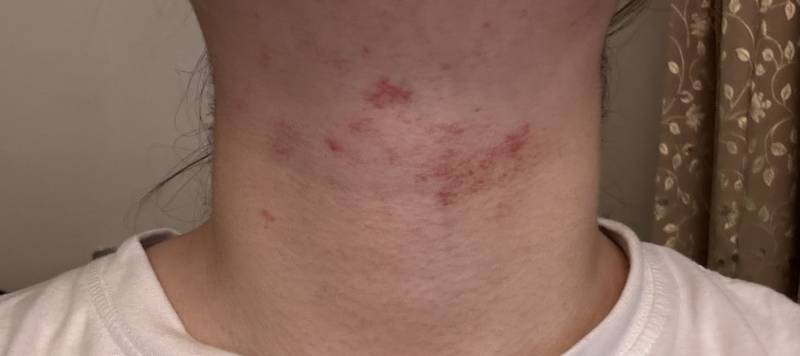 [잡담] 이거 피부 왜 이러는지 아는사람.. (ㅎㅇㅈㅇ) | 인스티즈