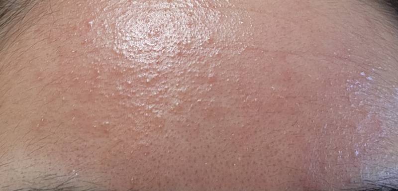 [잡담] 이마 좁쌀 어떻게 잡아?...ㅎㅇㅈㅇ | 인스티즈