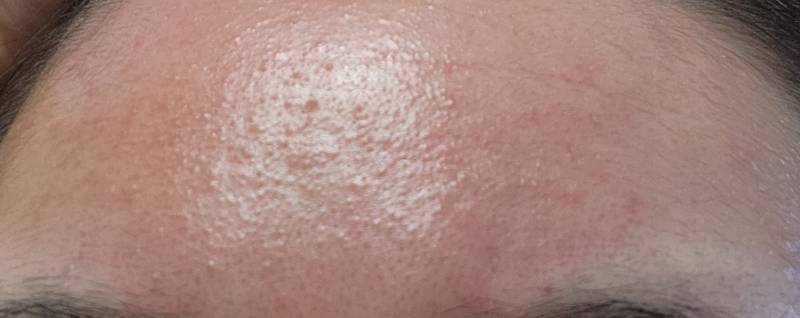 [잡담] 이마 좁쌀 어떻게 잡아?...ㅎㅇㅈㅇ | 인스티즈