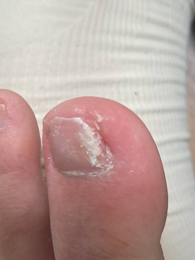 [잡담] 나 여기서 발톱 더 깍아도 되는거야? (ㅎㅇㅈㅇ) | 인스티즈