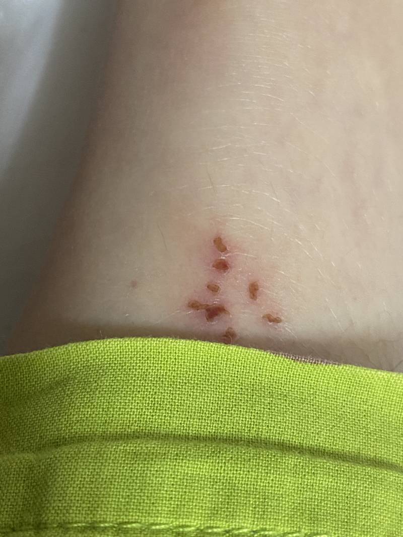 [잡담] 이거 뭐 물린자국인가? 사진있음 | 인스티즈