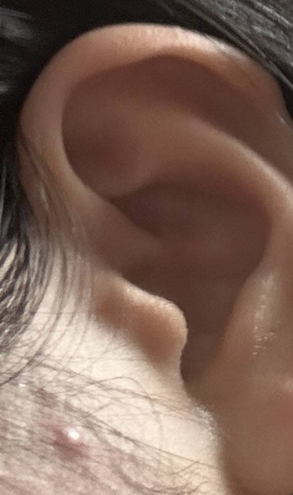 [잡담] ㅎㅇㅈㅇ 이 여드름 염증주사가 답인거같아보여? | 인스티즈