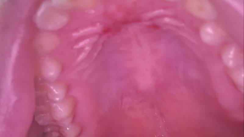 [잡담] 내 입천장 왜 이러는지 아는 사람? (ㅎㅇㅈㅇ) | 인스티즈