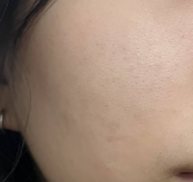 [잡담] 피부과 시술 잘 아는익들! | 인스티즈