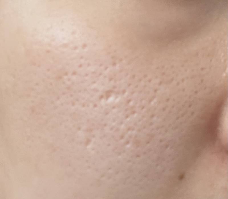 [잡담] 나보다 심한 곰보 잘 없을듯 | 인스티즈