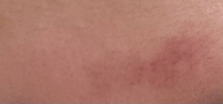 [잡담] 이마에 멍들어본적 있는사람ㅠㅠ | 인스티즈