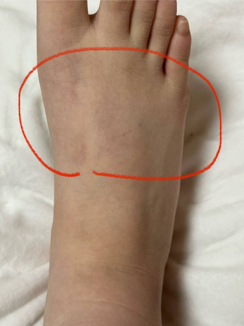 [잡담] 아까 저녁에 폼롤러로 발 아치 운동하다가 미끄러져서 넘어졌는데 발이 아파 (발 사진 있음) | 인스티즈