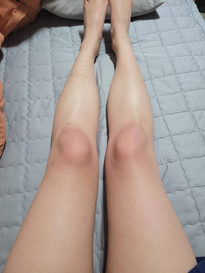 [잡담] 나 무릎만 익는 이유가 뭘까?? | 인스티즈