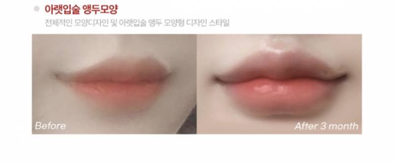 [잡담] 이런 입술필러 별로야?? | 인스티즈