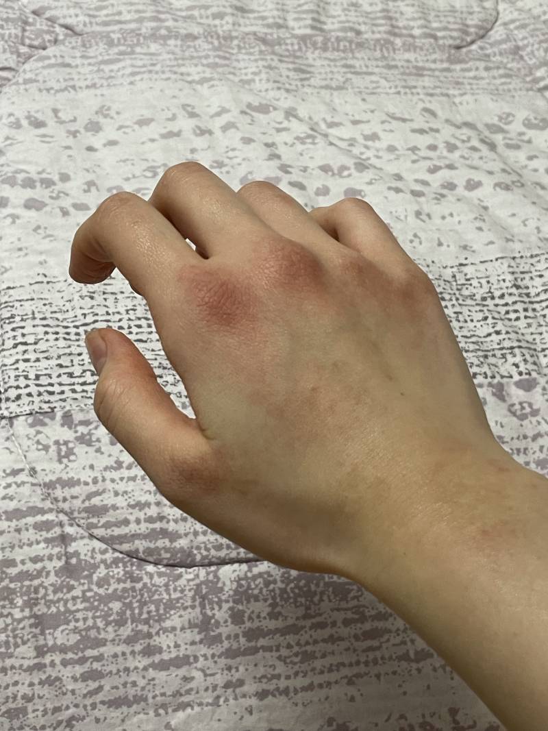 [잡담] 손이 너무 심하게 트는데 이거 왜이래ㅠ | 인스티즈