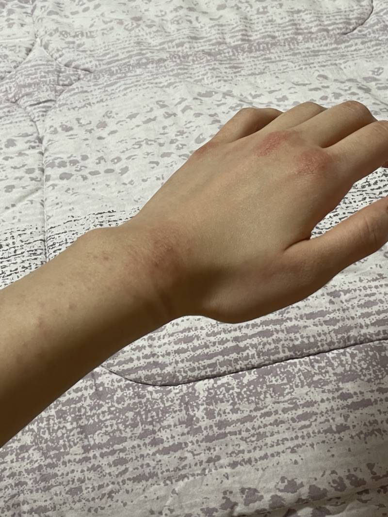 [잡담] 손이 너무 심하게 트는데 이거 왜이래ㅠ | 인스티즈