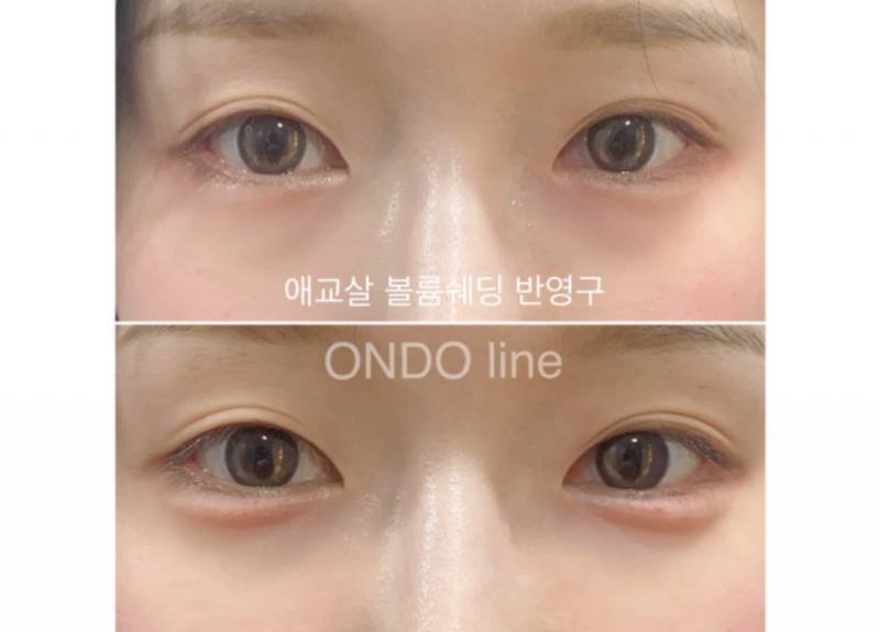 [잡담] 애교살 문신 할까말까….. | 인스티즈