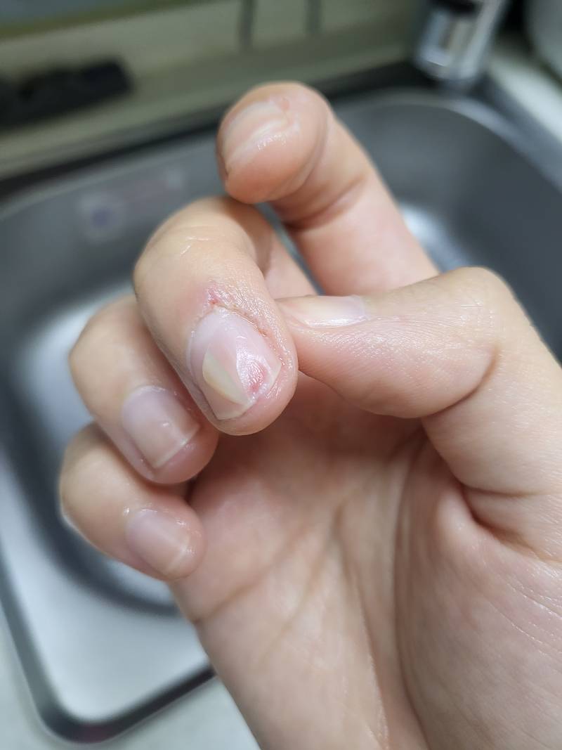 [잡담] (혐오주의) 이거 병원 가야할까...? | 인스티즈