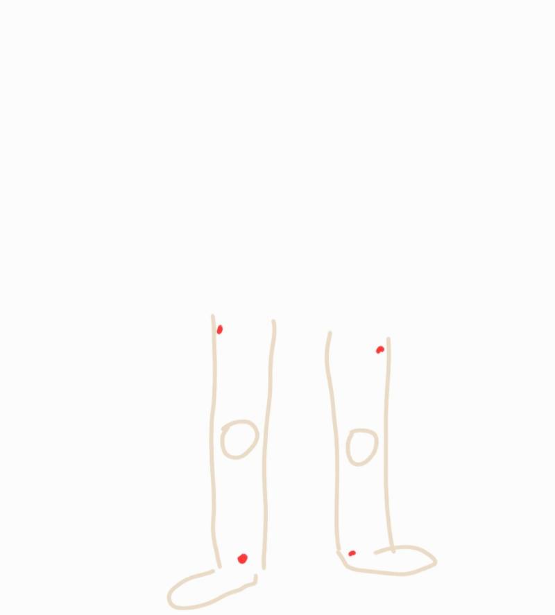 [잡담] 나 다리에 화상자국 있는데 이거 안 없어져? | 인스티즈